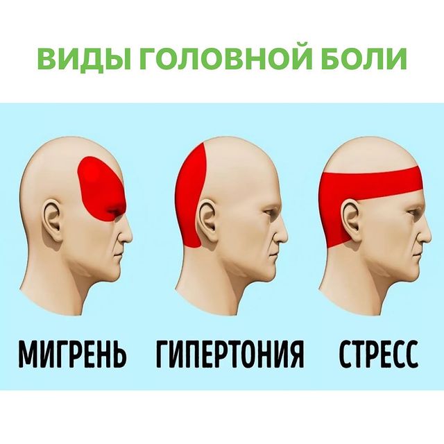 Головная боль напряжения&nbsp;&mdash; средняя или сильная боль во всей голове или в отдельной ее части