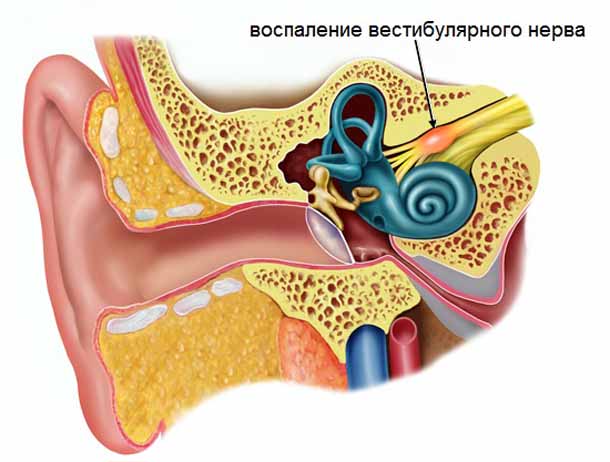 лечение рассеянного склероза
